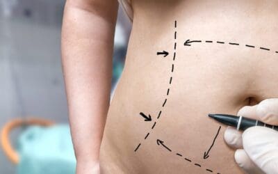 Kreitzberg Plastic Surgery Continues to Lead in High-Quality Tummy Tuck Services in Tulsa, Oklahoma