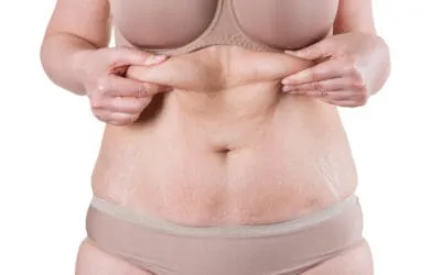 Tummy Tuck Surgery Right for You? Keys to Consider Before Making a Decision