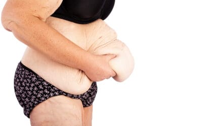 Achieve Your Ideal Contour: #1 Kreitzbergโs Post-Weight Loss Surgery in Tulsa