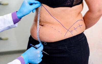 Kreitzberg Plastic Surgery Continues to Offer High-quality Tummy Tuck Surgery in Tulsa, OK