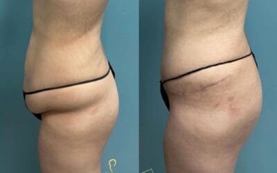 Kreitzberg Plastic Surgery Continues to Excel in Mommy Makeover Procedures in Tulsa, OK
