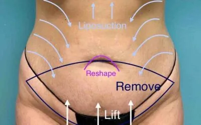 Tummy Tuck Transformation by Dr. Kreitzberg for Weight Loss After GLP-1 (Semaglutide) Injections in Tulsa, OK
