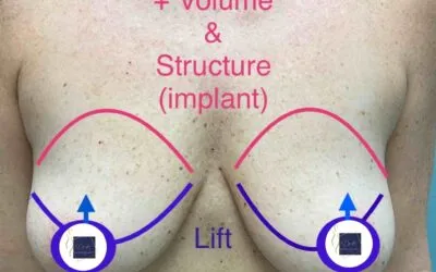 Which Procedure is Right for You? Breast Lift vs. Tulsa Breast Implants